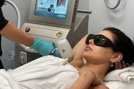 Underarm laser hair removal with an Alma Soprano system at Perfect B, medical aesthetics clinic in Doral, Miami, FL