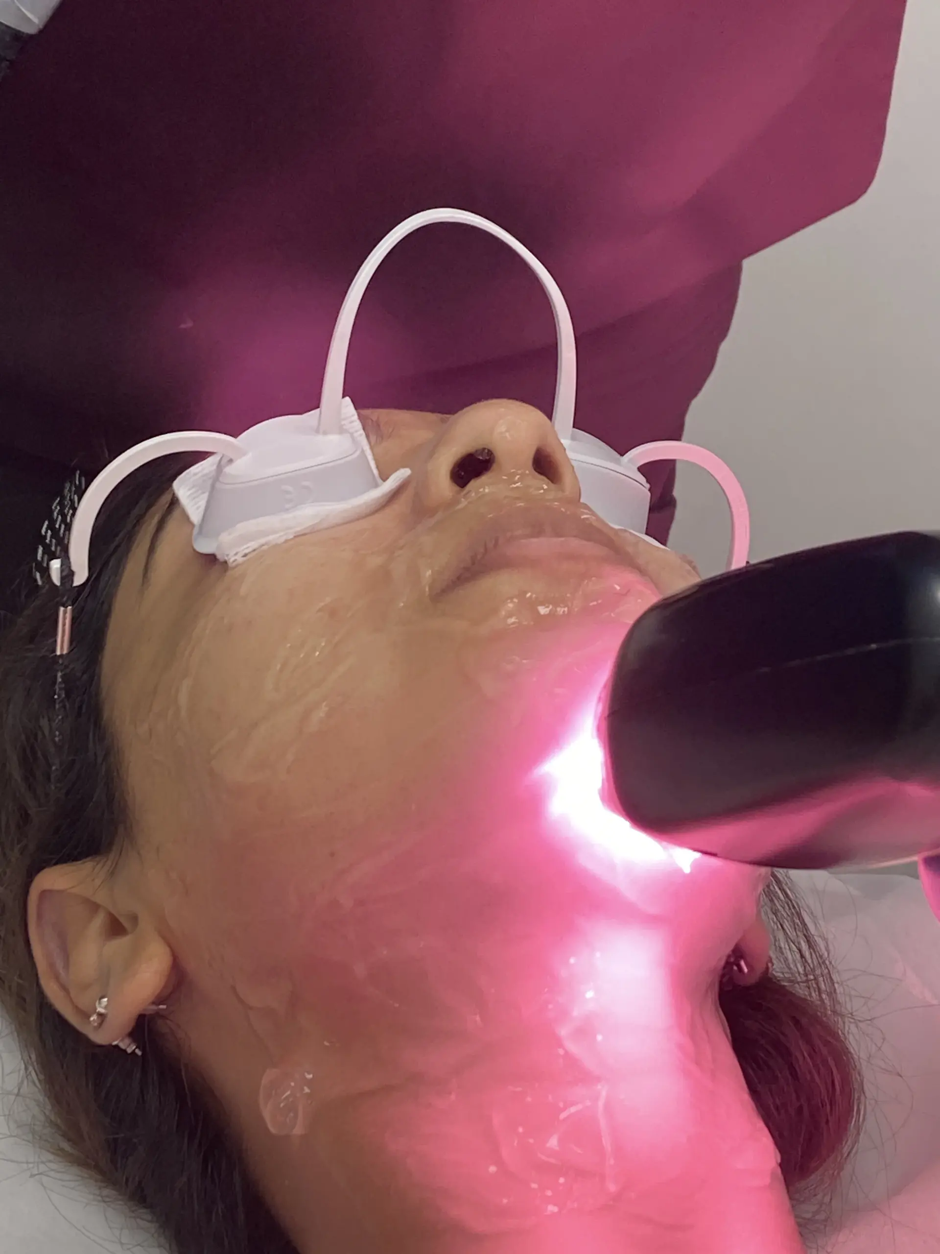 Perfect B - Blog - Everything you need to know about laser hair removal - patient wearing eye shields during a laser treatment at Perfect B in Doral, Miami, FL