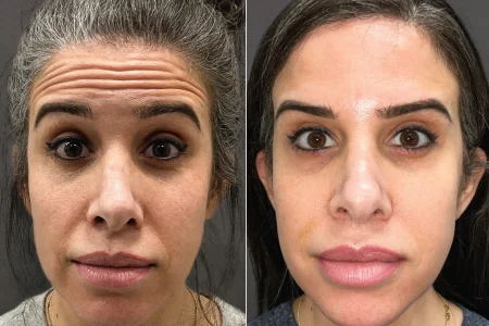 Neurotoxin Treatent before and after result (Case 8410) at Perfect B, medical aesthetics clinic in Doral, Miami, FL
