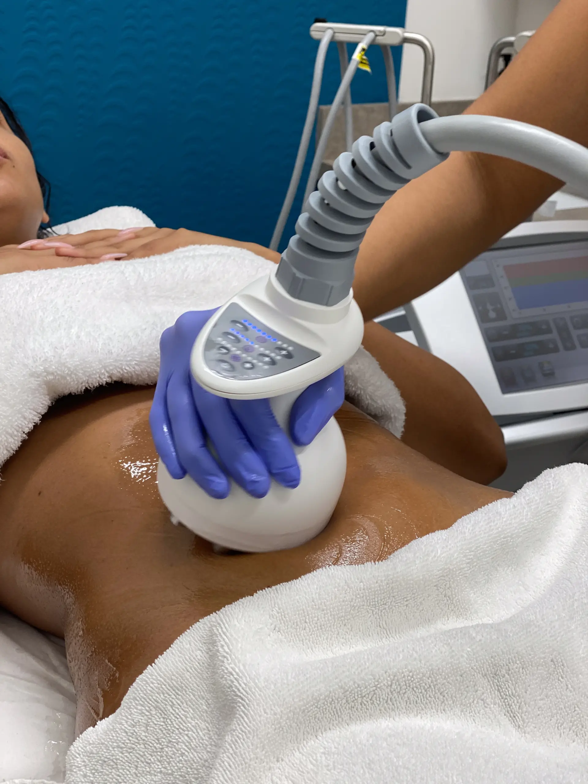 Perfect B - Blog - How to lose stomach fat after pregnancy - radiofrequency body treatment for skin tightening at Perfect B in Doral, Miami, FL