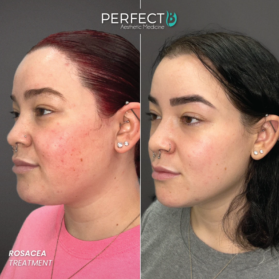 bpc-157 rosacea Polynucleotides for - Anti-Inflammatory and Rejuvenating Real Success Stories | Medical