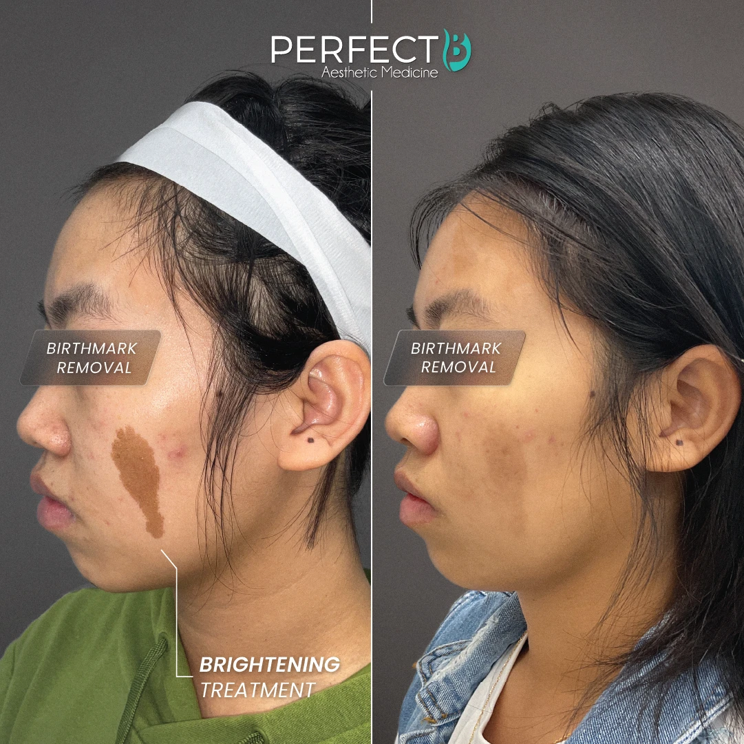 Brightening Treatment (Lesion Removal) - Perfect B - Results Image - Case 4503 KZ - 1080 x 1080