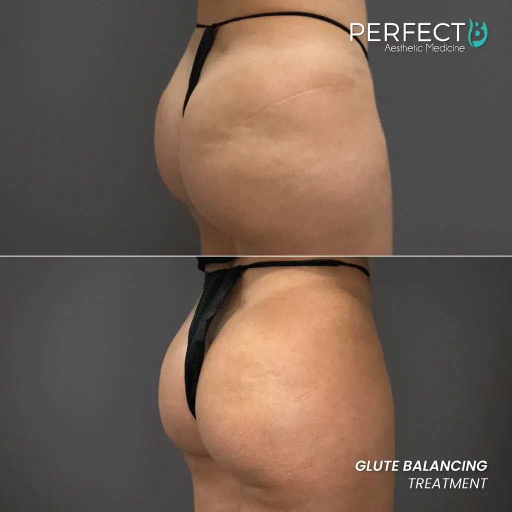 Non-surgical glute balancing treatment before and after results at Perfect B in Doral, FL