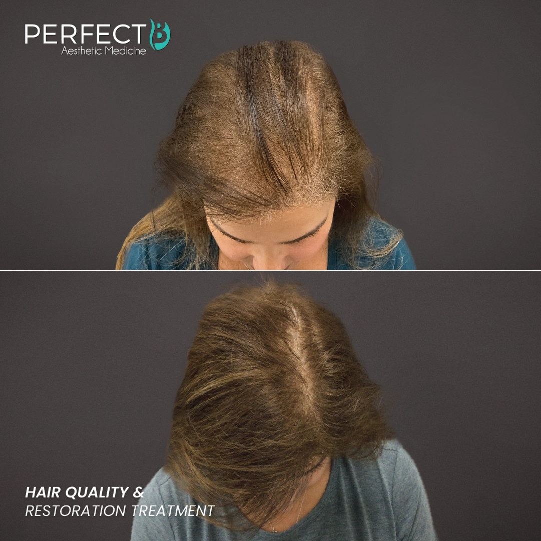 Perfect B - Blog - treatment for hair loss for women - hair restoration result for a female patient at Perfect B in Doral, Miami, FL