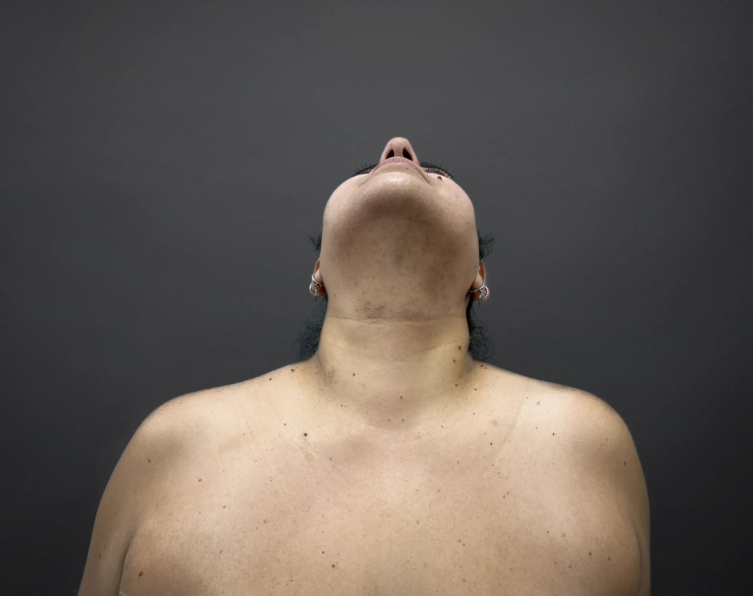 Close-up of a patient skin before mole and skin tag removal treatment at Perfect B