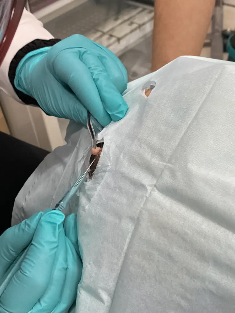Lesion removal treatment in progress at Perfect B aesthetic clinic in Doral, FL