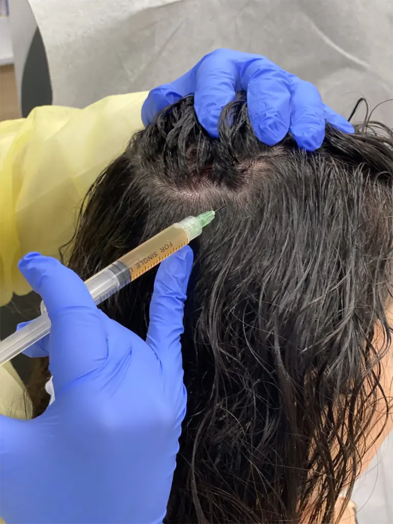does bpc 157 cause hair loss Treatment for hair loss for women
