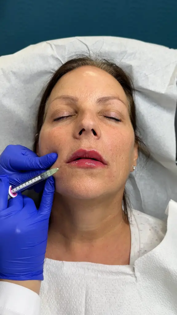 Close-up of a lip filler enhancement procedure at Perfect B aesthetic medicine clinic in Doral, FL