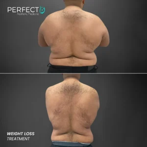 Perfect B - Results Image - [Weight Loss] 4007 - 1080 x 1080