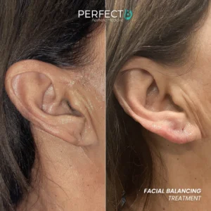 Perfect B - Results Image - [Facial Balancing] 4005 B - 1080 x 1080