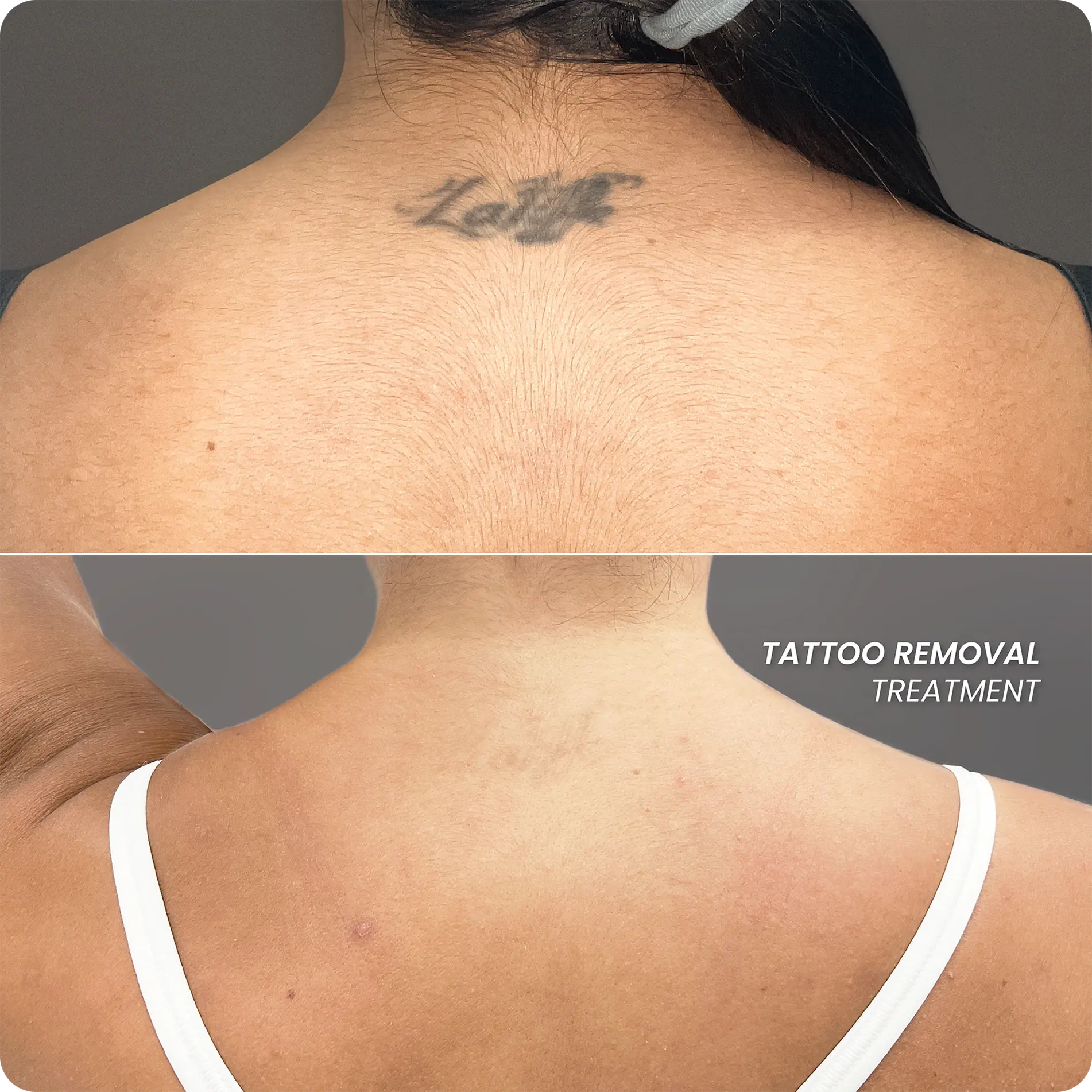 Lorem ipsum dolor sit amet, consectetuer adipiscing elit, sed diam nonummy nibh euismod tincidunt ut laoreet dolore magna aliquam erat volutpat. Tattoo removal results at Perfect B in Doral, showing faded ink after laser treatment sessions