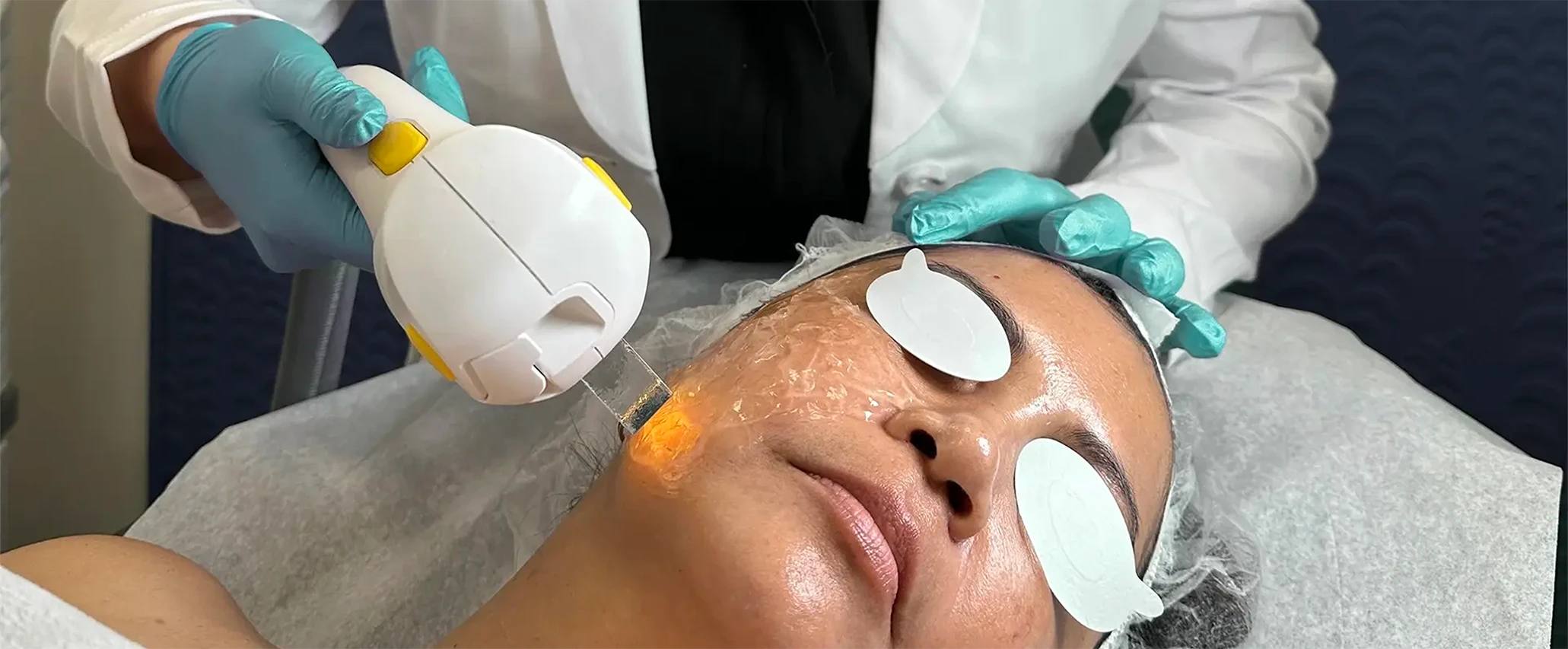 Hair restoration at Perfect B, medical aesthetics clinic in Doral, Miami, FL