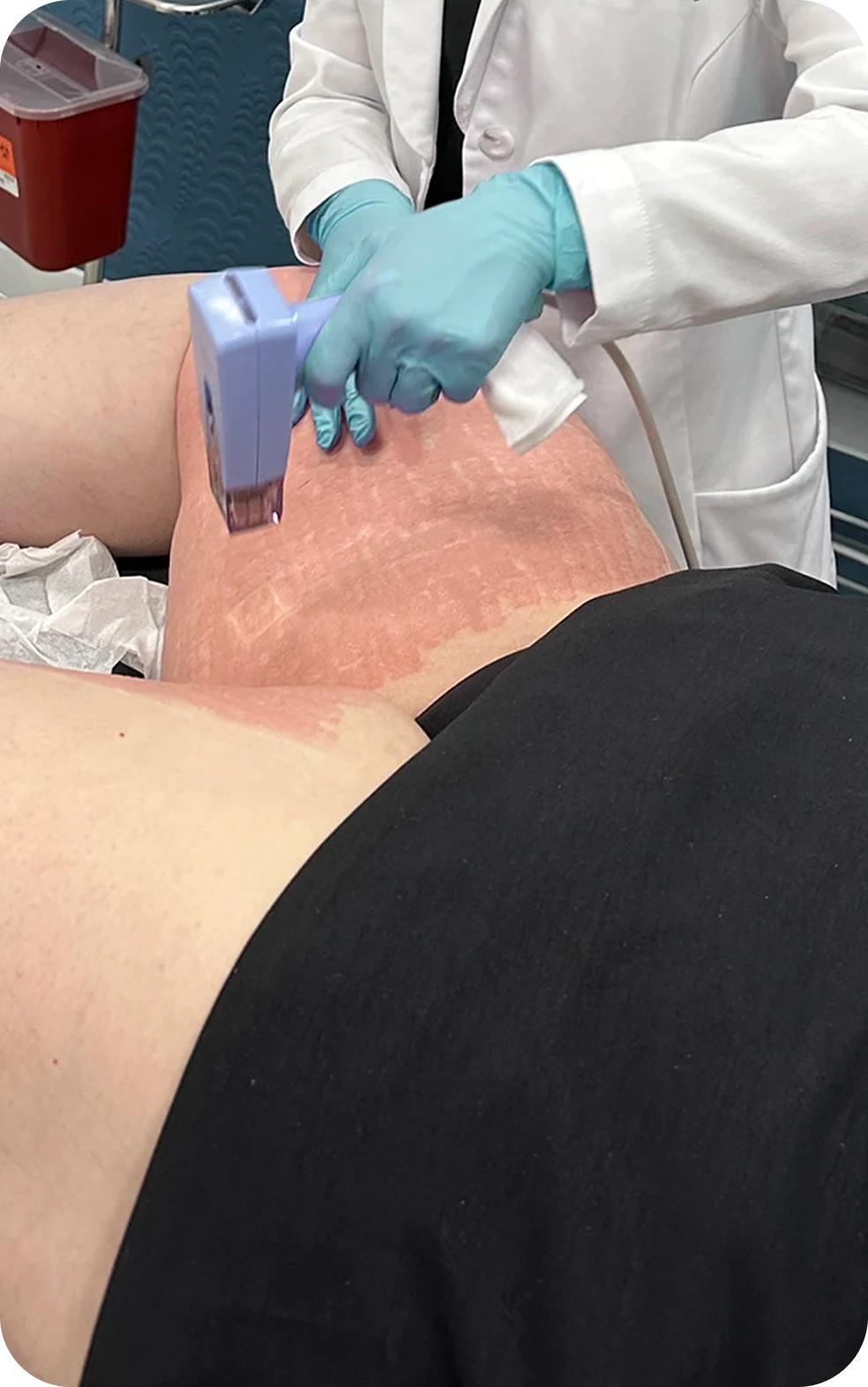 Woman reviewing loose skin concerns after weight loss during a Perfect B consultation