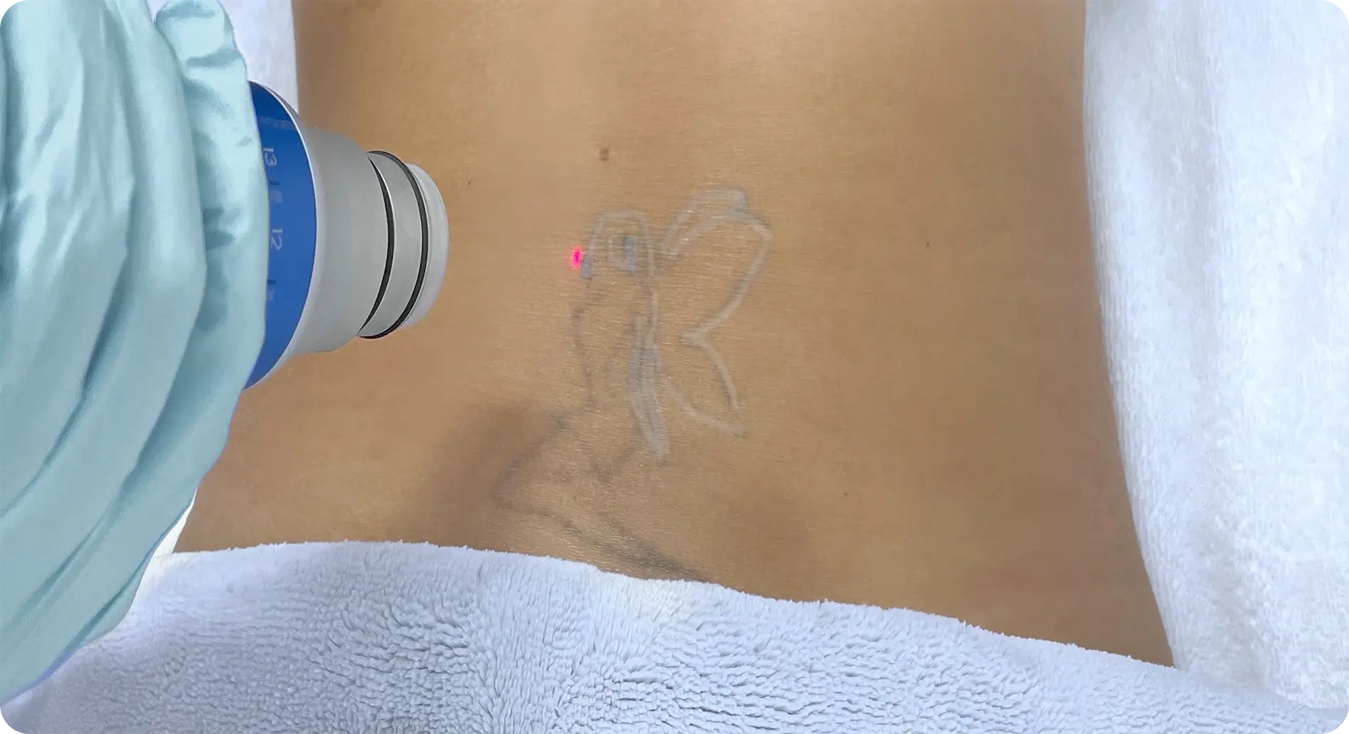 Close-up of faded, uneven eyebrow tattoo before laser correction at Perfect B in Doral, FL