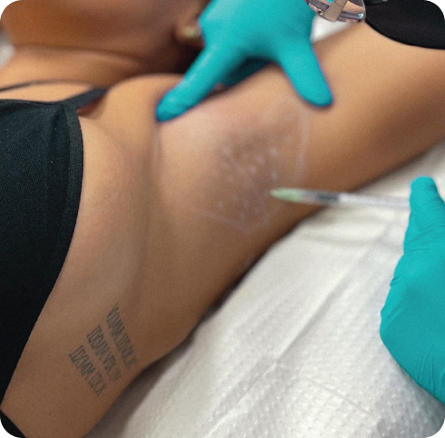 Perfect B - Neurotoxin Treatment - injection Botox hyperhidrosis