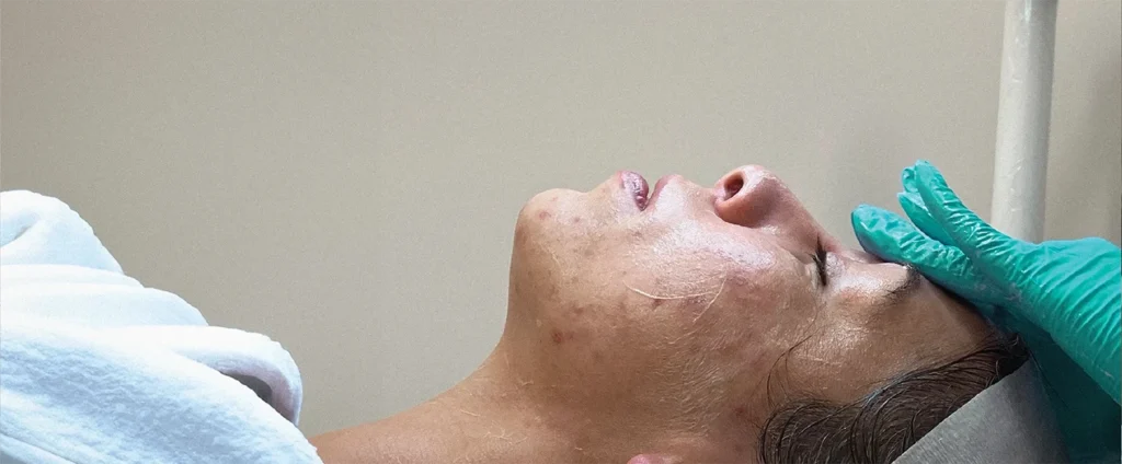 Perfect B - Blog - Cure Acne Vulgaris - Hero Image