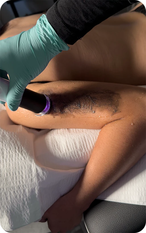 Close-up of uneven skin tone with sunspots and pigmentation that a glycolic acid peel at Perfect B can help brighten