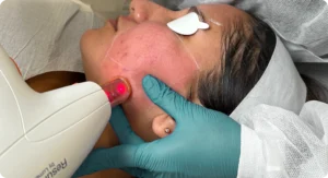 Laser skin treatment at Perfect B, medical aesthetics clinic in Doral, Miami, FL