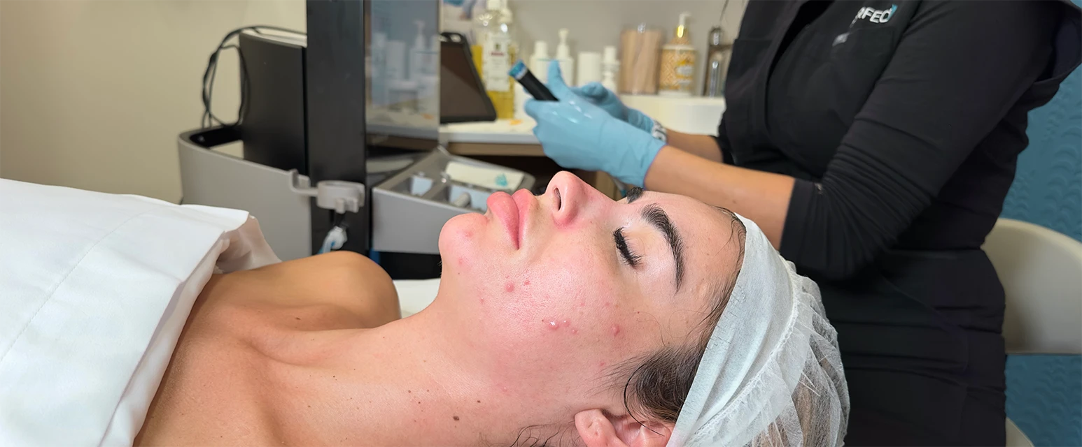 Perfect B - Blog - how to prevent hormonal breakouts - Hero image