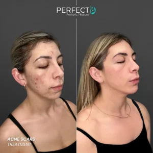 Perfect B - Results Image - [Acne Scars] 4003 - 1080 x 1080