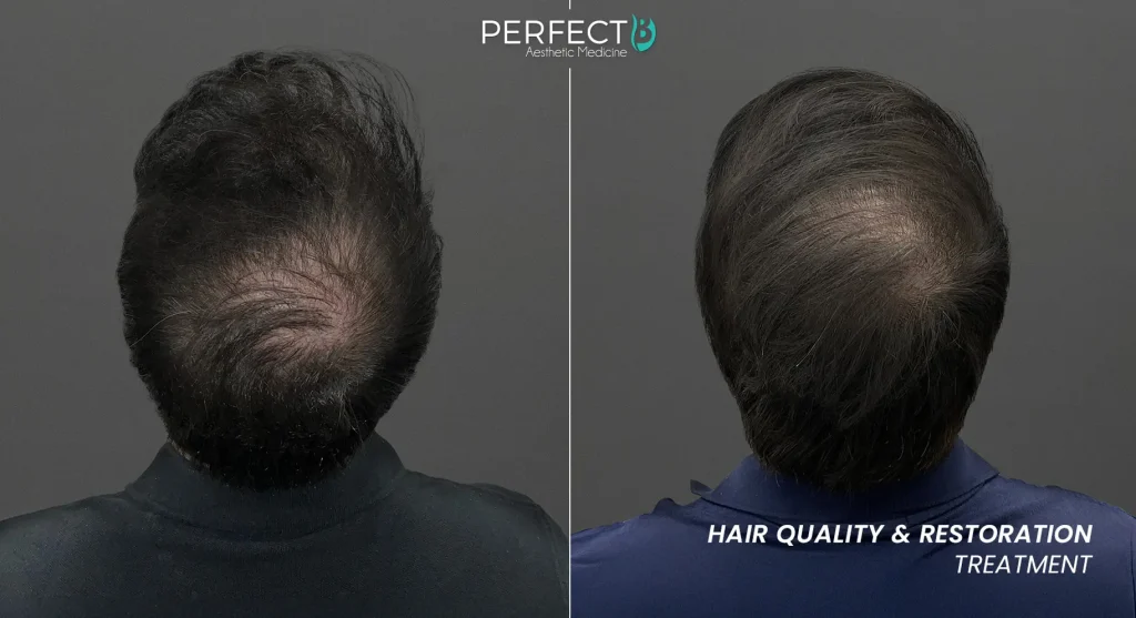 Hair regrowth timeline showing reduced shedding then visible density improvement between months four and six