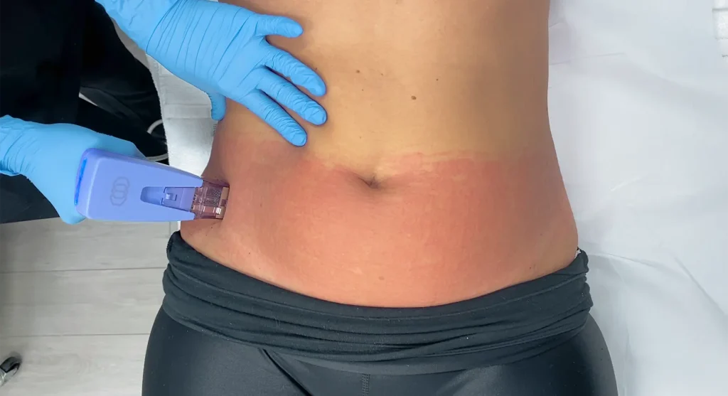 glp 1 treatment miami How Weight Loss Changes Your Face: What GLP-1 Patients Need to Know