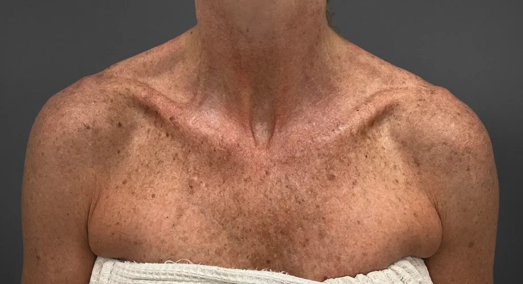 Flat brown sun damage spots from UV exposure treated with IPL and Pico laser in Miami