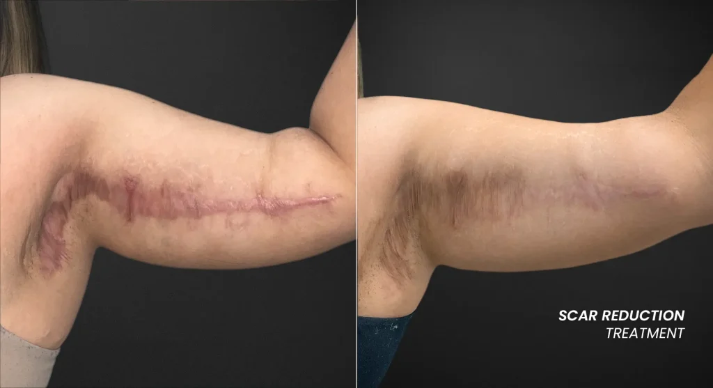Pigmented scars and birthmarks assessed by depth for a safe, personalized treatment plan