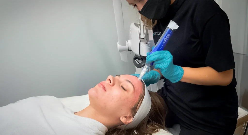 Close-up of the FDA-cleared SkinPen microneedling device used by providers at Perfect B in Doral