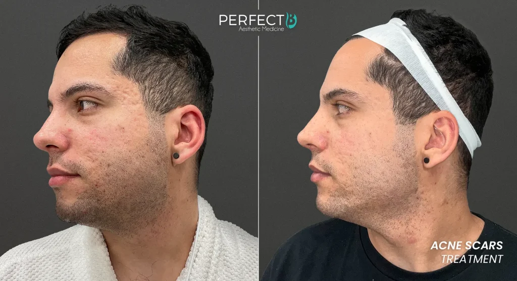 Illustration of microneedling helping to soften atrophic acne scars by rebuilding lost collagen