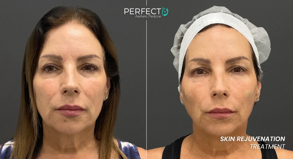 Microneedling to refine skin texture, minimize enlarged pores, and even out uneven skin tone