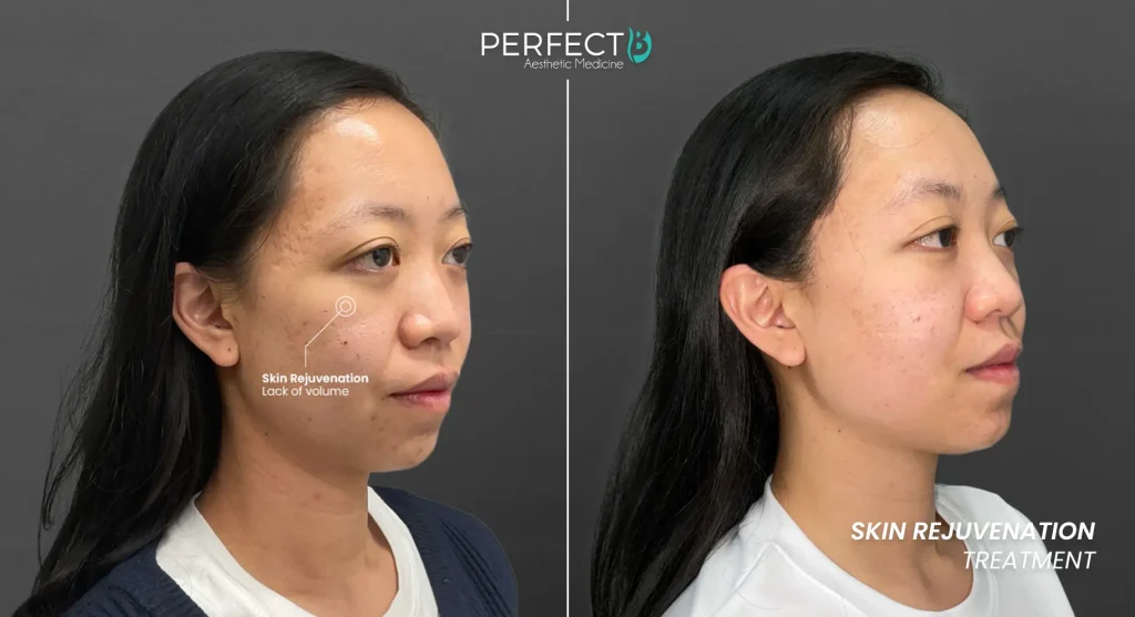 Microneedling supporting collagen to smooth fine lines and improve mild skin laxity over time
