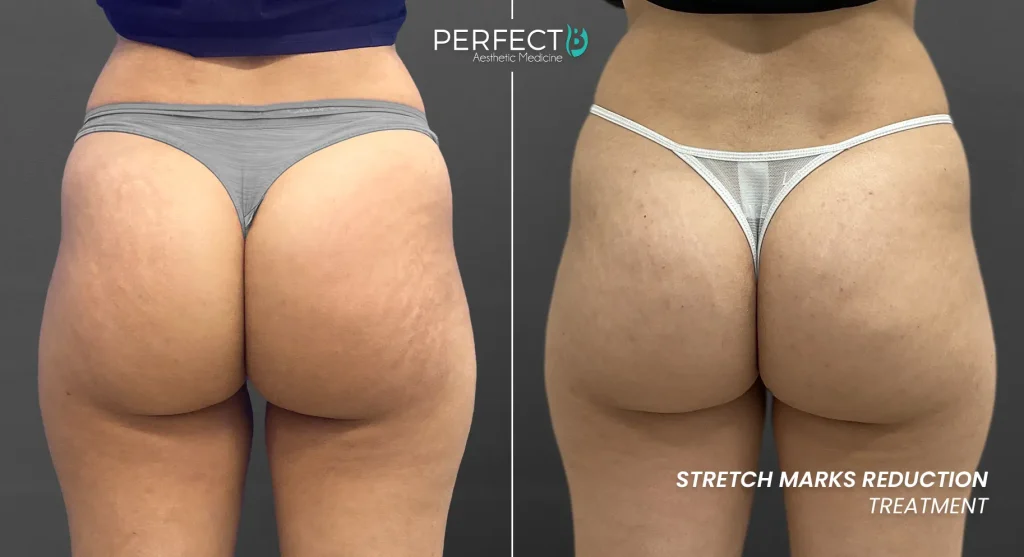 Microneedling stimulating collagen and skin repair to reduce the appearance of stretch marks