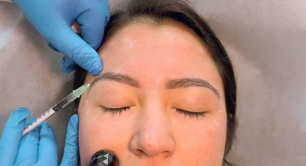 Smoother, more open eye area after neurotoxin relaxes the brow-depressing muscles for a gentle lift