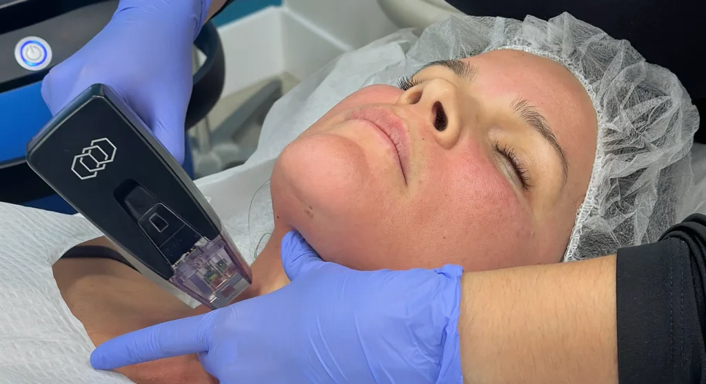 Firmer skin around the eye following radiofrequency skin tightening that stimulates collagen production