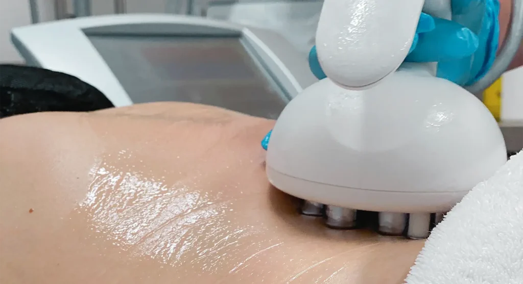 Post-lipo fibrosis scar tissue causing firmness and uneven skin texture during liposuction recovery
