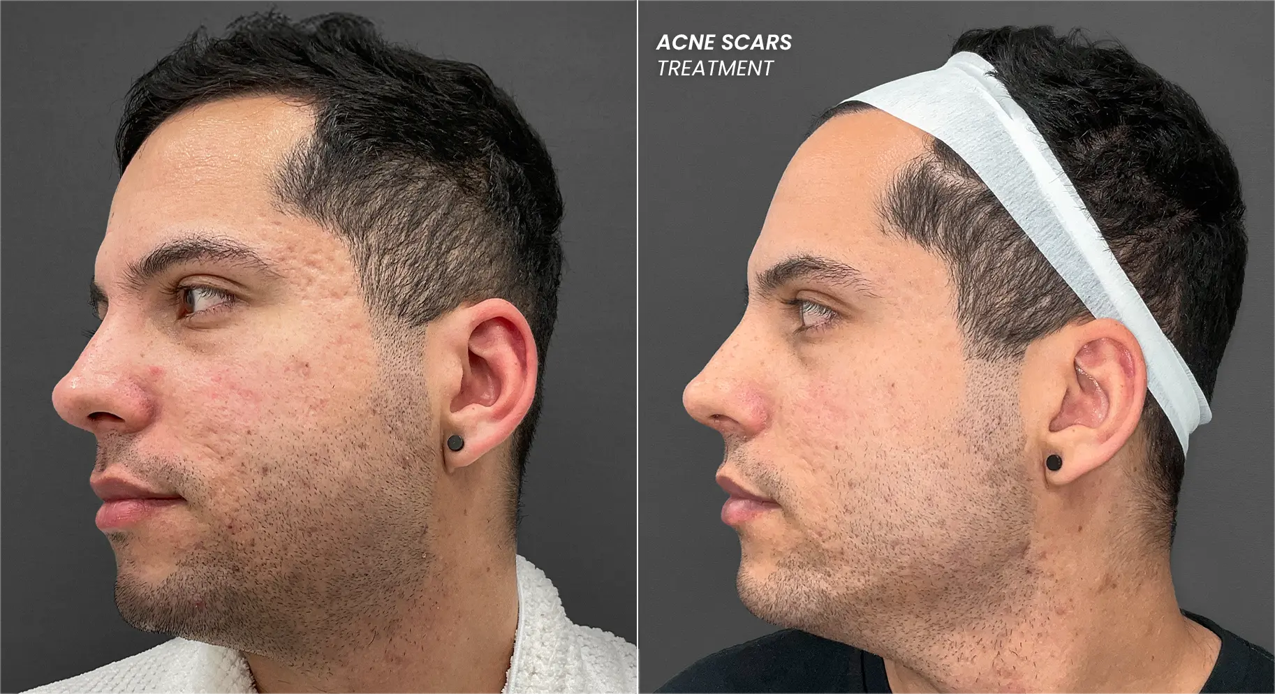Perfect B - Blog - Acne Scar Treatment Cost - patient reviewing an acne scar treatment plan and pricing with a clinician at a Doral clinic