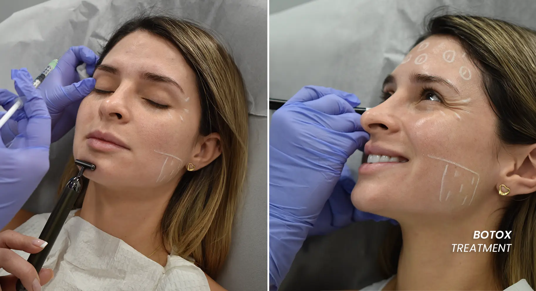 Perfect B - Blog - PDRN and Botox Same Day - a patient receiving a mapped Botox facial treatment in the clinic before a combined session