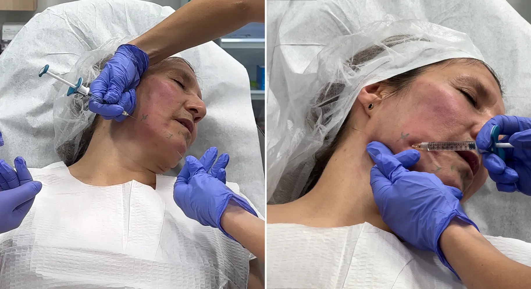 Perfect B - Blog - PDRN and Botox Same Day - a provider administering a precise facial injection during an in-office treatment