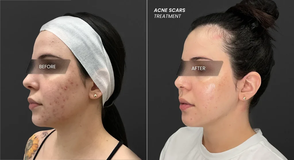 bpc 157 for acne Types of Acne Scars: Ice Pick, Boxcar, Rolling, and How Perfect B Treats  Each