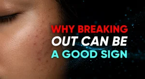 Perfect-B-Blog-Acne-Purging-Explained-portrait