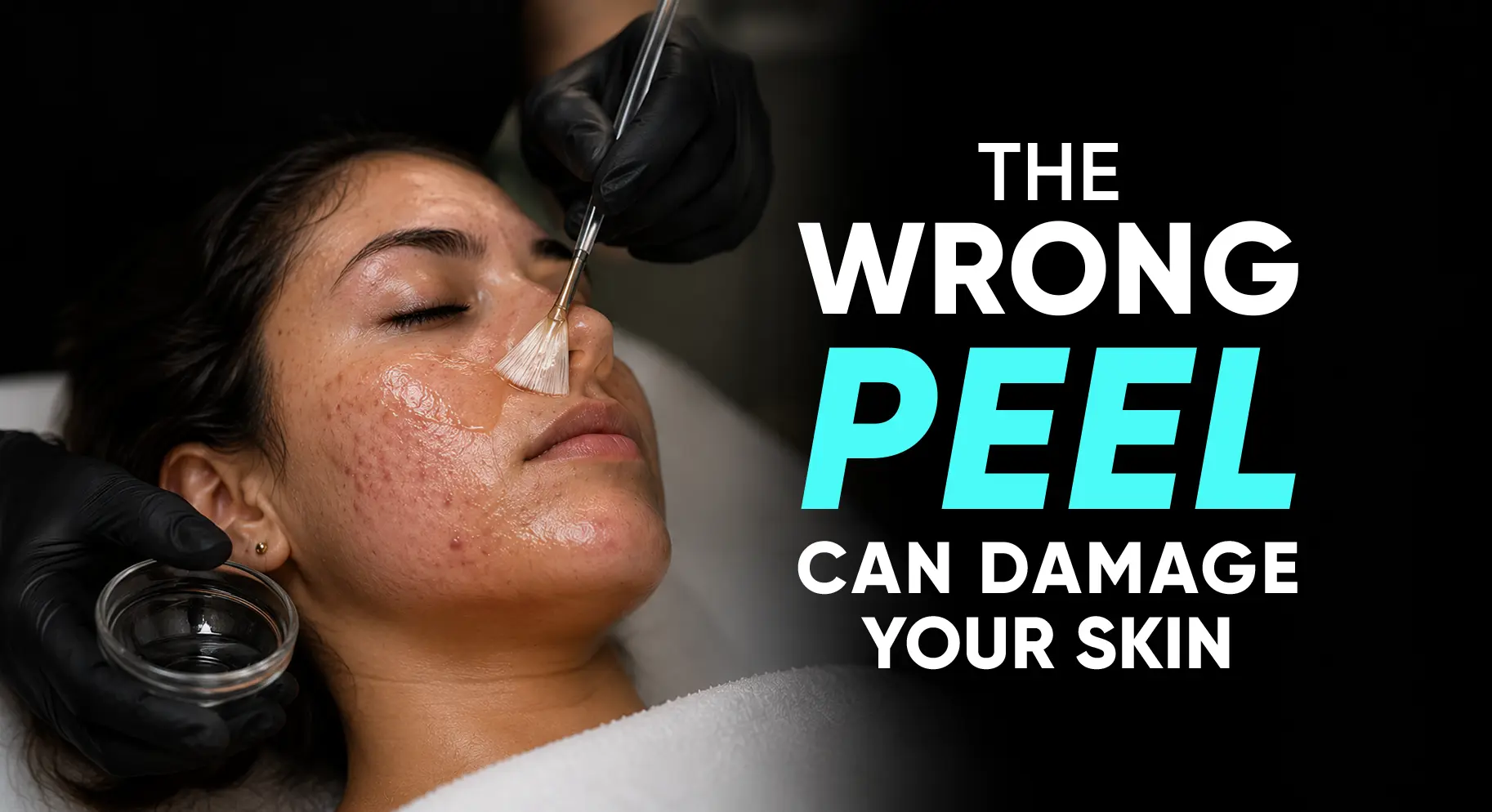 Perfect-B-Blog-Chemical-Peel-for-Acne-portrait