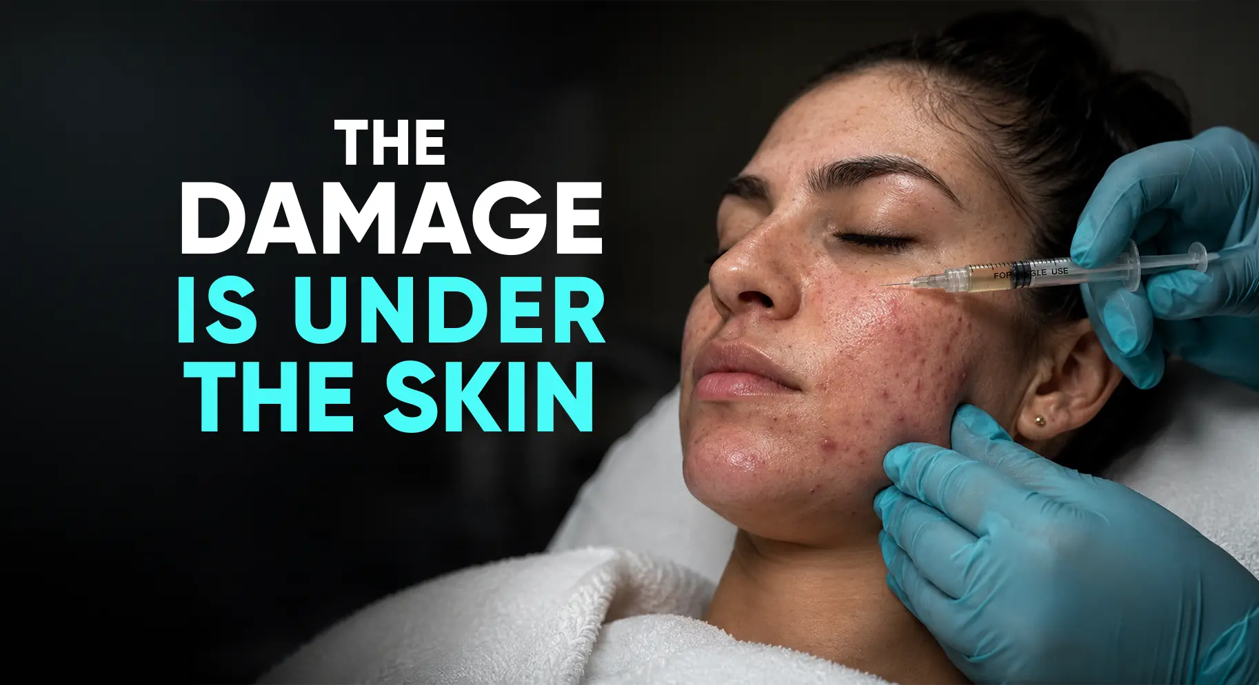 Perfect-B-Blog-Cystic-Acne-Treatment-portrait
