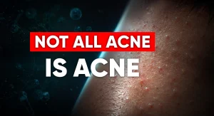 Perfect-B-Blog-Fungal-Acne-vs-Regular-Acne-portrait