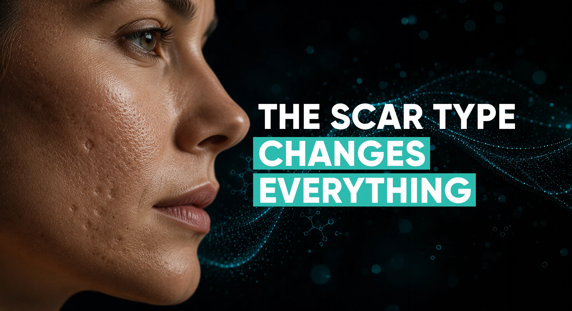 Perfect B in South Florida: Acne treatment and acne scar treatment