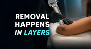 Perfect-B-Blog-How Many Sessions Does Tattoo Removal Take-portrait