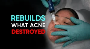 Perfect-B-Blog-Microneedling-for-Acne-Scars-portrait