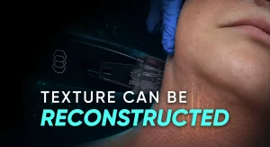 Perfect-B-Blog-RF- Microneedling-for-Acne-Scars-portrait