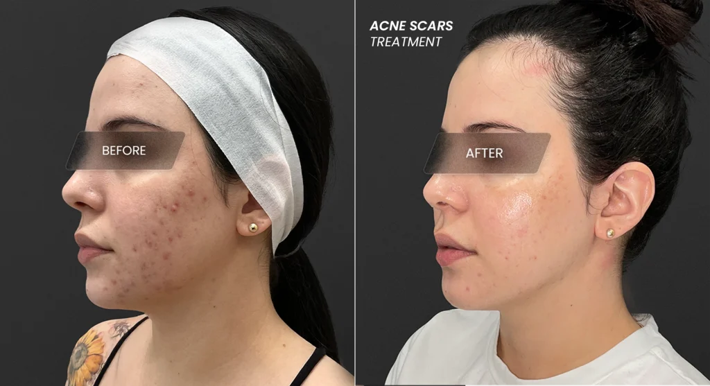Can Acne Scars Be Fully Removed? Perfect B Doral FL