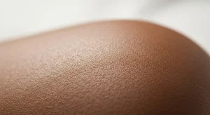 Perfect B - Blog - Dark Skin Acne Treatment - Healthy clear dark skin texture after Fitzpatrick-aware acne protocol